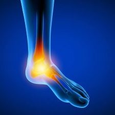3d rendered medically accurate illustration of a man having a painful foot.
